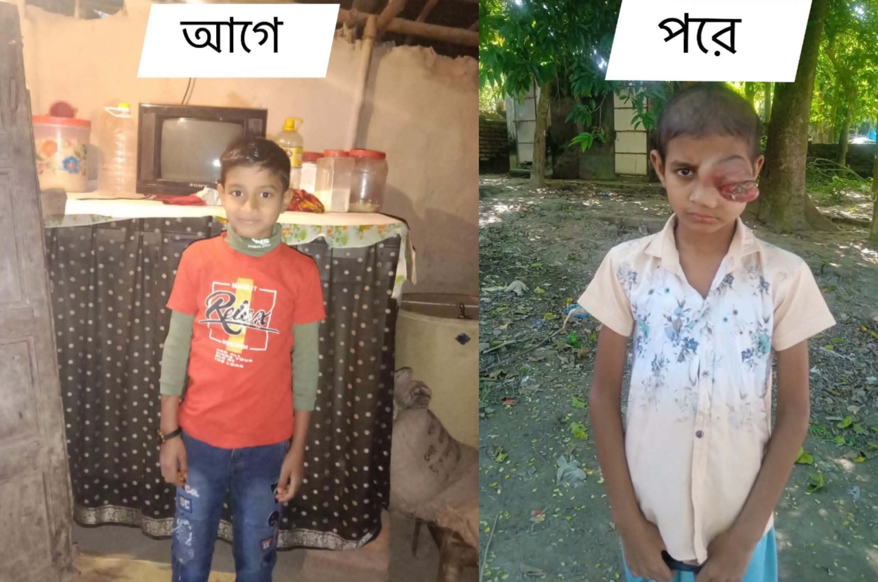 চোখের ক্যান্সারে আক্রান্ত ছোট্ট আসিক, চিকিৎসায় সহযোগিতার আকুতি